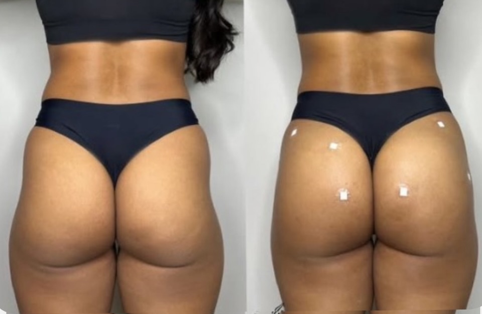 Preenchimento de glúteos antes e depois