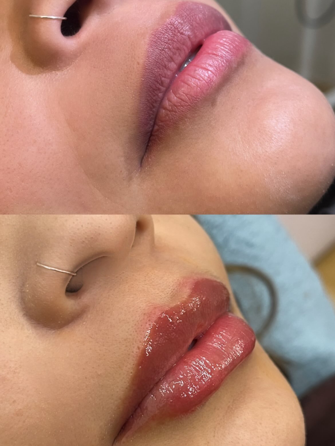 Preenchimento labial antes e depois