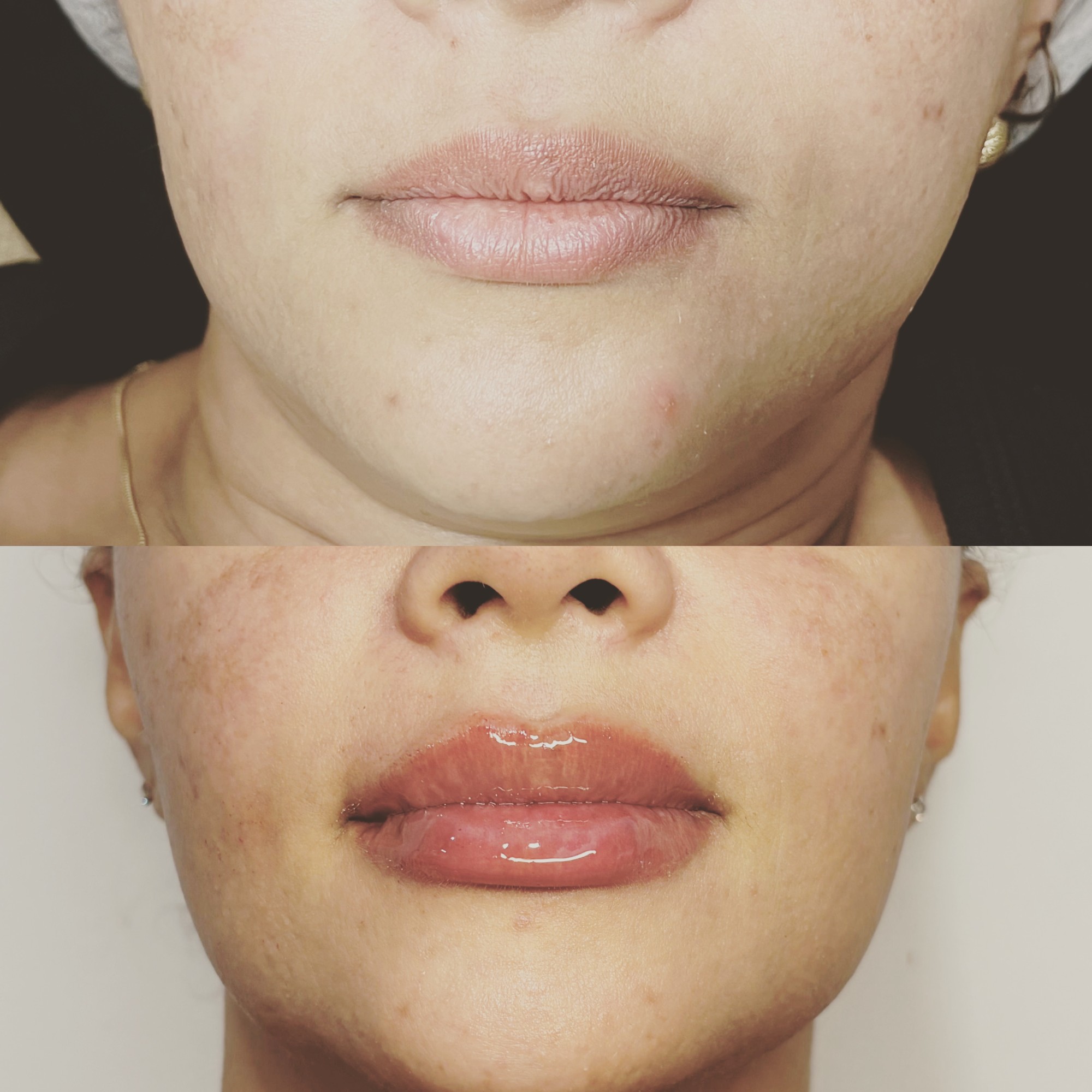 Preenchimento labial antes e depois